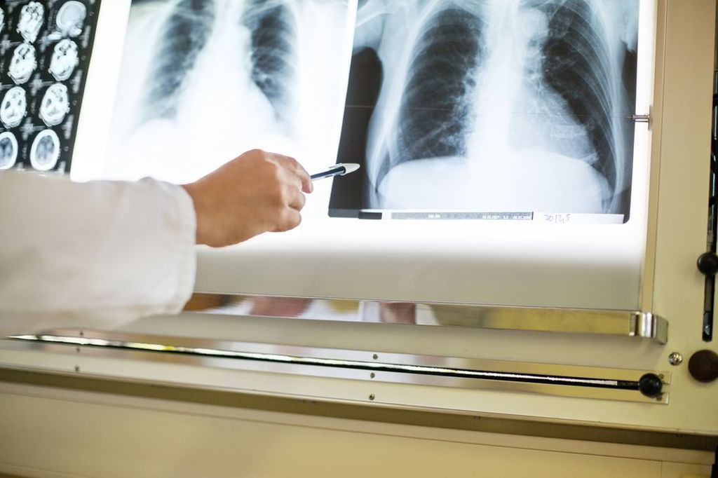 Photo of Asintomáticos podrían quedar con problemas graves en los pulmones