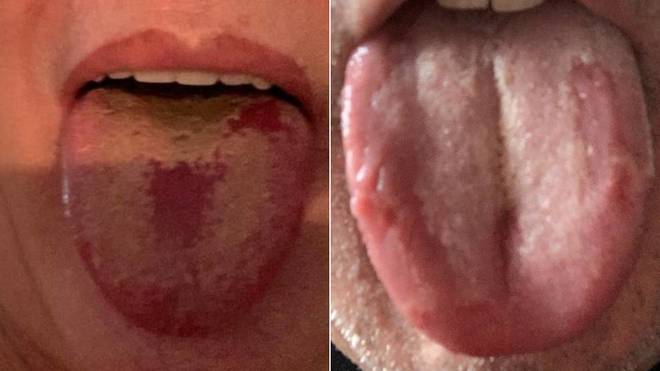 Photo of Alertan sobre otro síntoma asociado al coronavirus