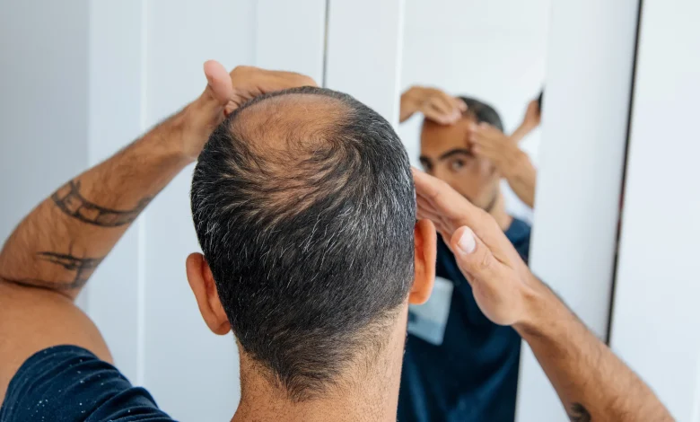 ¿Perderás el cabello? Esto es lo que realmente acelera la calvicie en hombres
