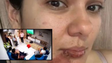 Photo of Mujer sufrió graves quemaduras en su rostro cuando se comía una empanada; le “explotó” en la cara