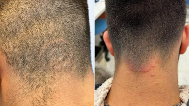 Photo of El “hongo de las barberías” que preocupa a especialistas en salud y que puede causar caída del pelo