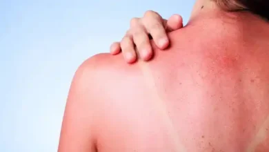 Photo of 3 trucos baratos que pueden salvar tu piel si te insolas en Semana Santa