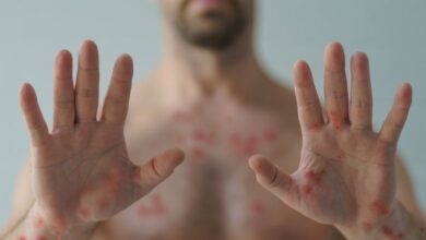 Photo of Ministerio de Salud confirma el primer caso de variante de la viruela símica en el país
